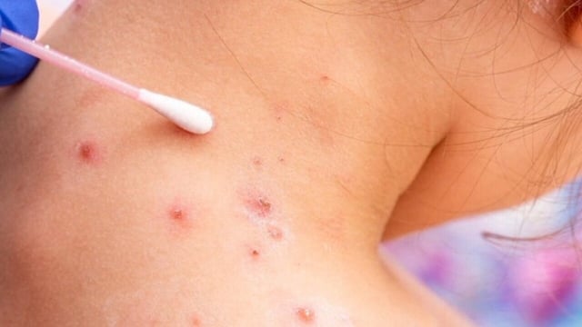 measles 5-15.25